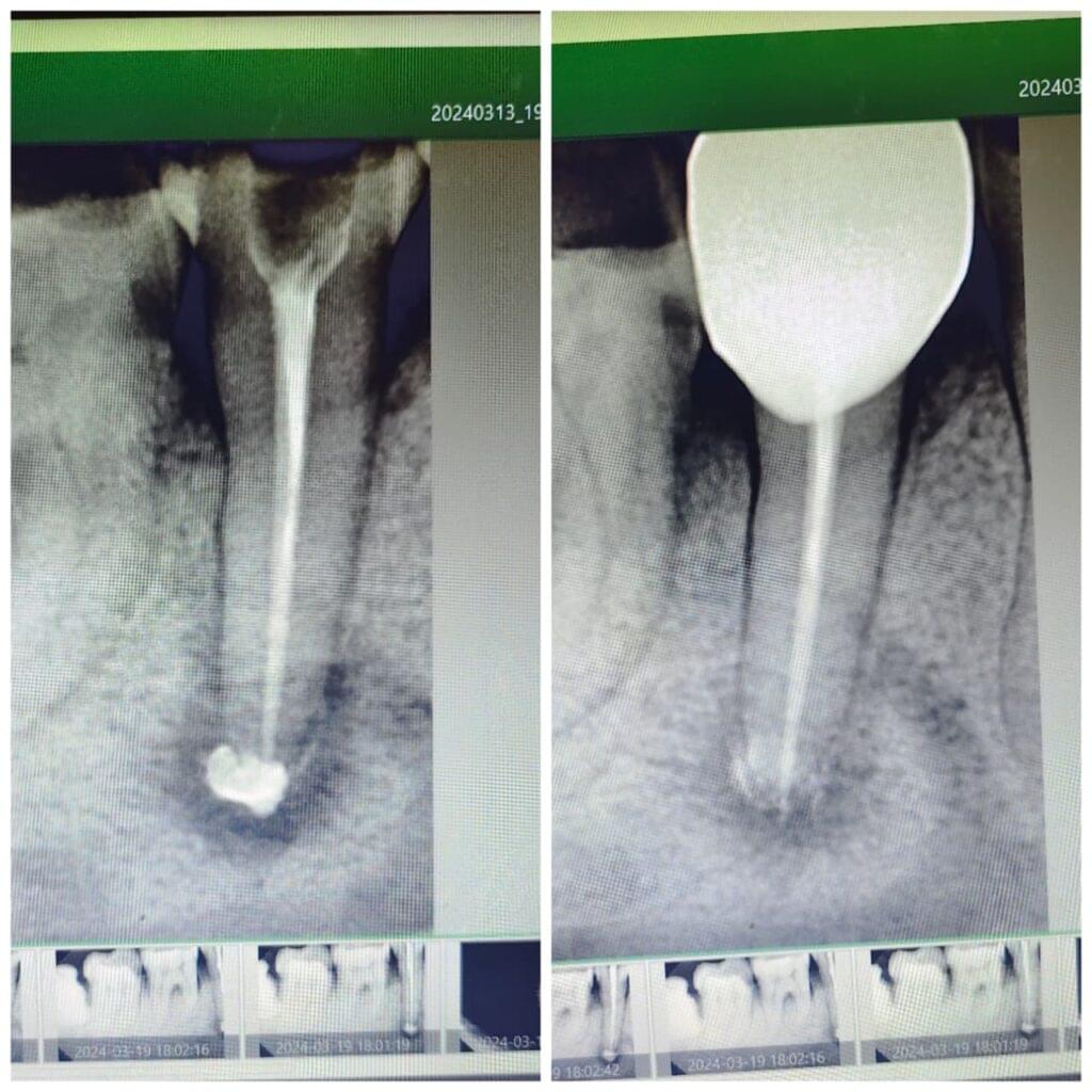 Real Tooth Rct Dentist in Ballygunge Kolkata | Dr. Sen’s Dental Care Centre